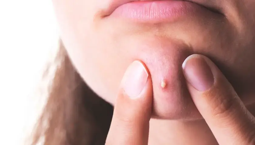 Pryszcz w 24h? Zmniejsz i ukryj! Szybki poradnik SOS