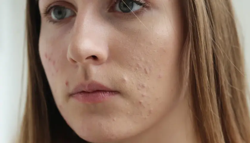 Sudocrem na pryszcze: Działa? Kiedy używać, by nie zaszkodzić?