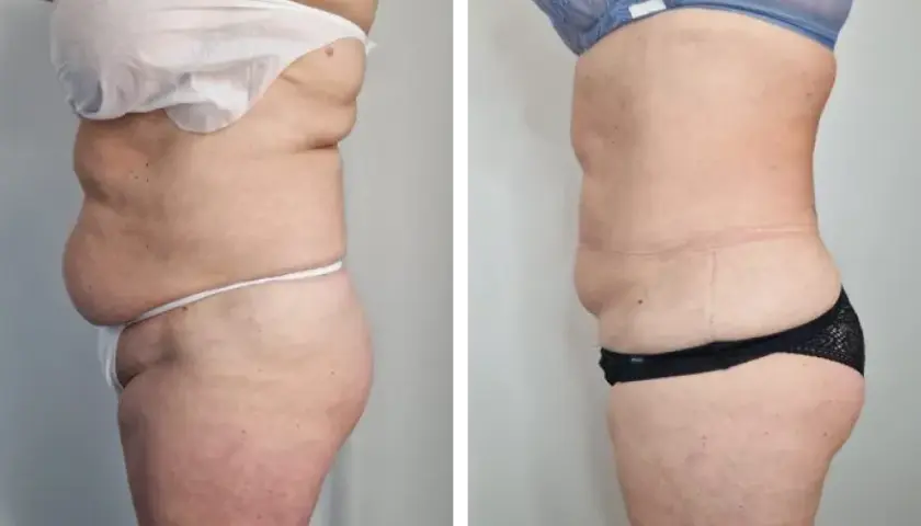 Liposukcja: Co to, metody, efekty i koszty? Pełny przewodnik!