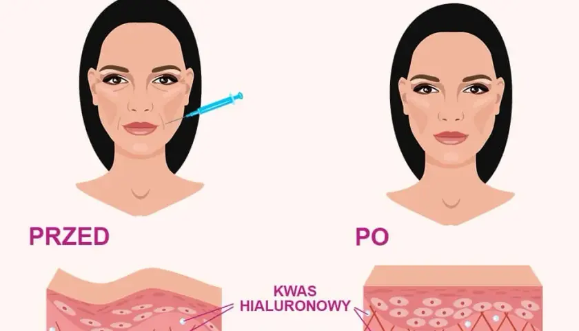 Kwas hialuronowy: jak działa i dlaczego Twoja skóra go pokocha?
