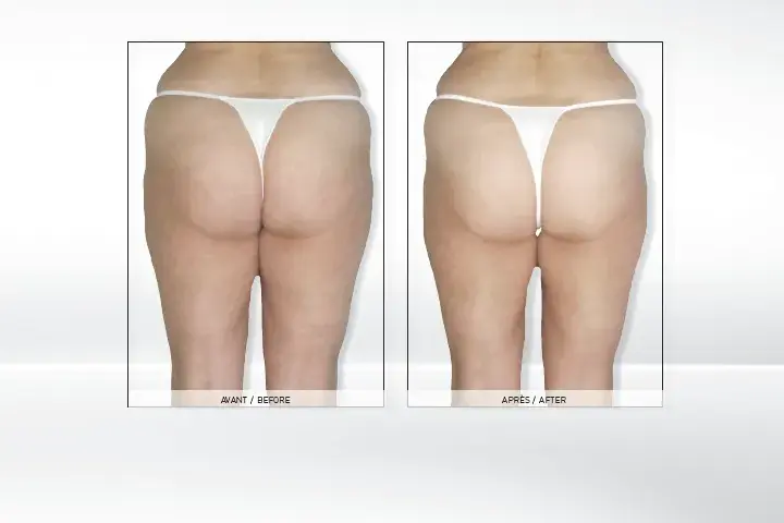 Endermologia: Kiedy efekty i jak utrzymać je na dłużej?