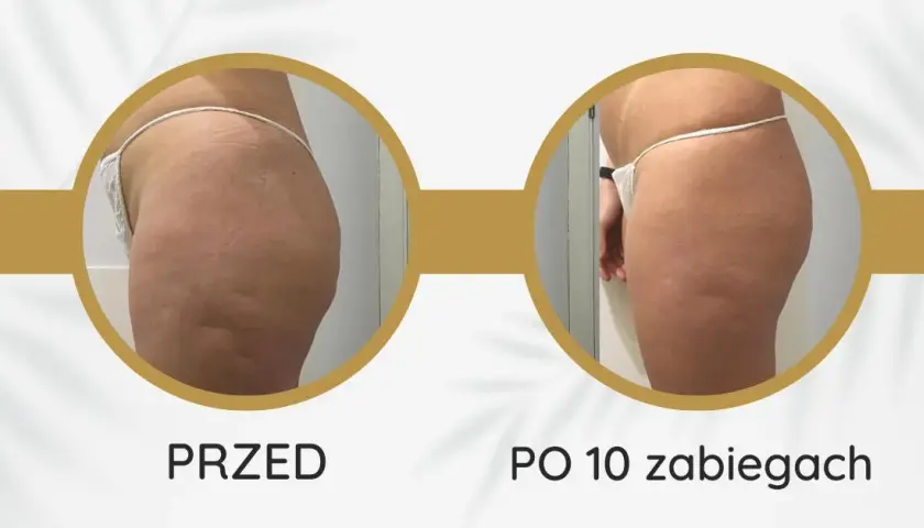 Endermologia: Gładka skóra bez cellulitu? Poznaj efekty i fakty