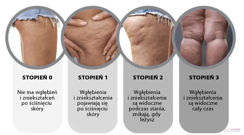 Jak pozbyć się cellulitu? Kompletny przewodnik po domowych i zabiegach