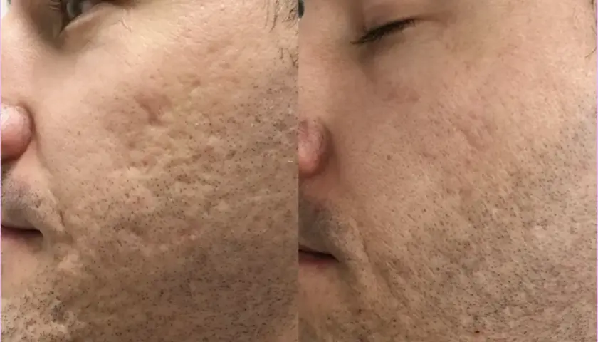Laser frakcyjny nieablacyjny: Czy to najlepsza inwestycja w skórę?